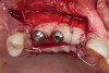 Fig 9. The implants and healing caps were placed.