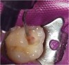 Fig 2. Once hemostasis was established, pulp capping was performed by applying a light-cured, resin-based, tricalcium- and dicalcium-silicate filled liner in a thin layer as a barrier to protect the dental pulpal complex. The liner was then light-cured.
