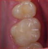 Fig 3. The tooth was restored in layers and, at the 6-month recall, was totally asymptomatic. Good marginal integrity was maintained.