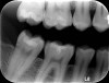 Fig 5. The 6-year radiograph confirmed the dentin bridge formation achieved with the tricalcium- and dicalcium-silicate material.