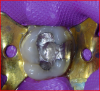 Fig 6. Patient presented with a failed amalgam restoration. Patient experienced spontaneous pain and could not eat. Although the first inclination may have been to perform endodontics, re-restoration was performed.