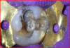 Fig 7. Upon removal of the failed amalgam restoration, remnants of the previously placed and now broken-down calcium-hydroxide liner were observed, along with recurrent caries and stained margins in the left lobe from microleakage.