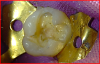 Fig 8. The calcium-hydroxide liner was removed, as was the underlying carious dentin. The microleakage stain on the left lobe was removed after photographing.