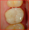 Fig 10. Post-treatment view of the molar that was restored using a universal composite and bioactive composite restorative. After composite placement, occlusion was adjusted, slightly into the cuspal contact.
