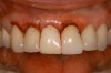 Figure 18 – Immediate placement of temporary crown over the abutment; laser crown lengthening was performed on the adjacent teeth to improve gingival symmetry