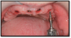 Fig 4. The spherical abutments were screwed into place using a dedicated abutment driver.