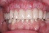Fig 8. Facial view of the maxillary full-arch prosthesis following immediate loading and attachment using a removable fixed attachment system.