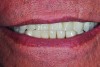 Potential “All-on-4” patient with terminal dentition who was unhappy with his smile esthetics.