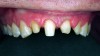Fig 7. Crown preparations, teeth Nos. 7 through 10.