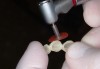 Fig 10. Adjustment of provisional restoration.