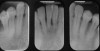 Fig 18. Preoperative radiographs of periodontally compromised mandibular anterior teeth that are treatment-planned for a direct placement fiber-reinforced resin splint.