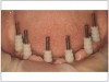 Fig 22. Parallel placed implants with pins in place following fully guided surgery.
