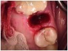 Fig 7. View of an expanded socket following tooth extraction according to the atraumatic technique.