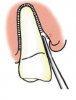 Fig 8. For single-rooted teeth, a PDL knife is used to “navigate” the PDL space, severing the ligament and displacing the root simultaneously.
