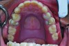 Fig 12. Occlusal view of maxillary RPD at time of insertion.