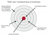 ADMINISTRATION APPROACH (2.) The “bull’s eye” administration of anesthesia for endodontic treatment.