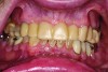 Fig 17. Completed maxillary overlay acetal resin removable partial overdenture.