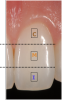 Fig 1. When restoring pink esthetics, the fourth dimension of color encompasses the gingival architecture, or pink.