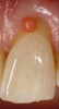 Fig 4. Close-up view showing the pink composite shade estimation on the gingival tissue.