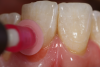 Fig 15. All margins were approximated using a polishing disc with semi-spherical particles, an effective approach for when working in tight gingival spaces and to help micromanage the pink part of the restoration.