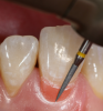 Fig 17. A yellow flamed diamond bur kit was used for imparting microtexture across all restorations.