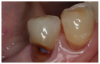 Figure 1: Root Caries<br>Courtesy of <a href-"http://dentalcare.com" target="_blank">dentalcare.com</a>
