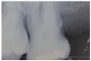 Figure 2: Radiographic Image of root caries<br>Courtesy of <a href-"http://dentalcare.com" target="_blank">dentalcare.com</a>