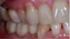 Fig 13. Initial placement; note tissue deficit on buccal gingival margin of tooth No. 31.