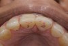 Fig 7. Resin build-up accomplished for palatal surfaces to restore lost form.