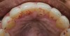 Fig 14. Postoperative view showing additively restored palatal surfaces of upper anteriors.