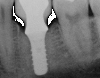 Fig 5. View of a radiograph taken of an implant in September 2009.