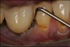 Fig 17. The implant had a 12-mm mesial pocket depth, a 12-mm distal pocket depth, bleeding on probing, and perioral exudate.