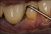 Fig 17. The implant had a 12-mm mesial pocket depth, a 12-mm distal pocket depth, bleeding on probing, and perioral exudate.