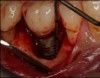 Fig 18. The patient accepted treatment, and a flap was made. Surface decontamination was achieved without endangering the inferior alveolar nerve.