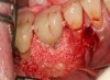 Fig 19. Biologic bone grafting was performed using a combination of mineralized bone and anorganic bone with a biologic.