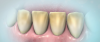 Figure 1. Stained teeth prior to whitening treatment.