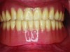 Fig 14. Complete polished denture.
