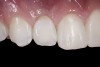 (4.) Double-wing metal resin-bonded (Maryland) bridge replacing the right lateral incisor (facial view).