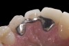 (5.) Double-wing metal resin-bonded bridge replacing lateral incisor (lingual view).