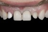 (9.) Veneer preparations of incisors and zirconia abutment of right lateral incisor, 13 days after exposure of implant head (second stage surgery).