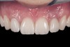 (10.) Implant crown and incisor veneers 14 days after exposure of implant.