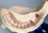 Figure 7: Preoperative triple tray impression of two teeth for which a bridge is planned shows an edentulous space between the two future abutments.