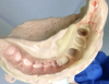 Figure 11: An initial, unrefined temporary bridge inside a preoperative impression just after removal of the preoperative impression from the mouth; material that has overflowed the
abutment margin(s) will be cut away with scissors while the temporary restoration is still soft.