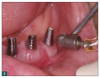 Fig 5. The HST air-polishing system can be used to clean implant abutments, without concern about damaging the surfaces.