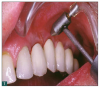 Fig 7. Air polishing can be performed around implant-retained prosthetic restorations.