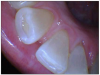 Figure 1. Attrition exposing dentin on tooth #25.