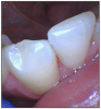 Figure 2. Facial surface exhibiting flattened, smooth, polished enamel wear on tooth #23.
