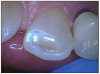 Figure 3. Lingual and occlusal surfaces exhibiting polished wear on tooth #5.
