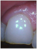 Figure 4. Jagged, chipped and thinning enamel on the incisal edge.