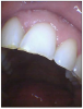 Figure 5. #9 – small chips #10 – flat, smooth incisal